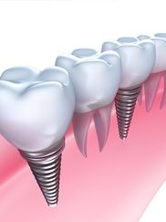 Murcia Dental implantes dentales